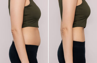 BodyTits antes y después liposucción sin cirugía